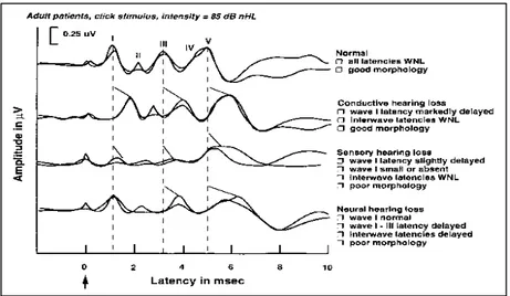 Gambar 4. Hasil pemeriksaan ABR pada pendengaran normal dan KP. 4 (Dikutip dari James W, Patrick J, Antonelli