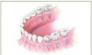 Gambar 5. Restorasi Implan Dental untuk edentulous lengkap (a) & (b) implant and tissue-supported overdenture (c) all implant-supported overdenture 