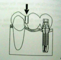 Gambar 8.  Non rigid connector (Engelman, M.J, 1996) 