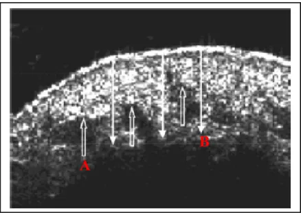 Gambar 3.1. Hasil gambar US Imaging frekuensi tinggi memperlihatkan lekukan  hipodermal (A) dan ketebalan kulit (B)