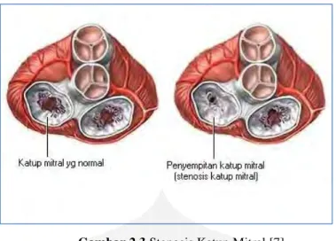 Gambar 2.3 Stenosis Katup Mitral [7]