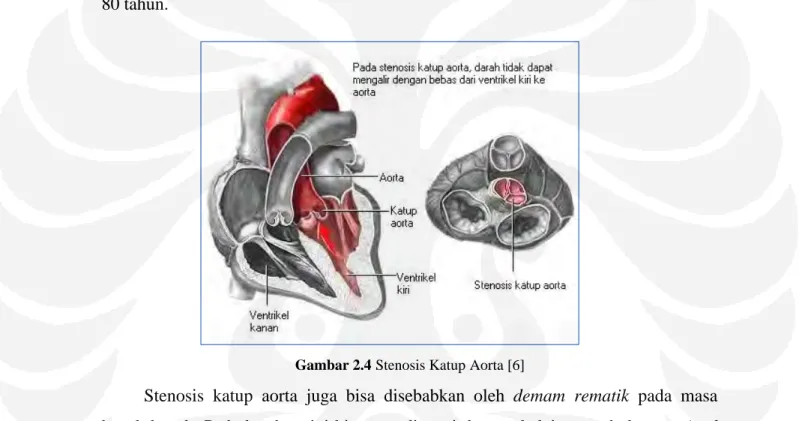 Gambar 2.4 Stenosis Katup Aorta [6]