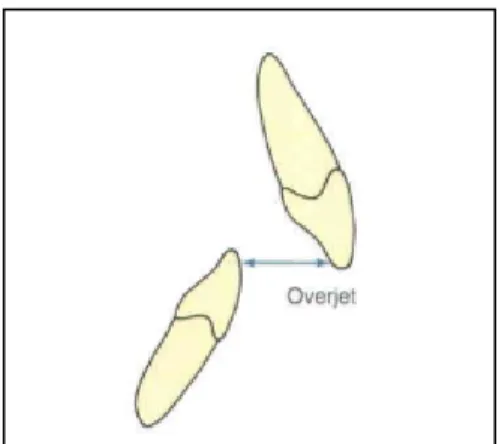 Gambar 7. Overjet 28