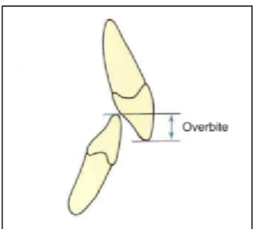 Gambar 8. Overbite 28 