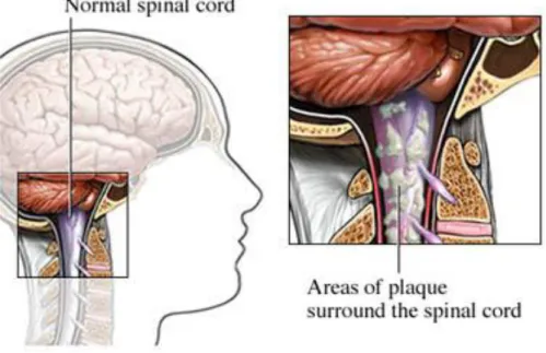 Gambar 3. Multiple sclerosis pada system saraf (dikutip dari  kepustakaan 7)  Lama-lama  penyakit  ini  akan  semakin  memburuk  secara  perlahan