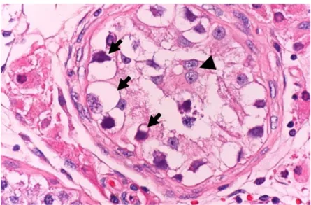 Gambar 6. Intratubular Germ Cell Neoplasia. 