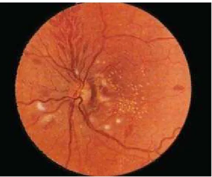 Gambar 2.1 Klasifikasi retinopati hipertensi: stadium 1,  stadium 2, stadium 3, stadium4