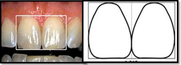 Gambar 6.  Pengukuran lebar kedua gigi insisivus sentralis   maksila 7 