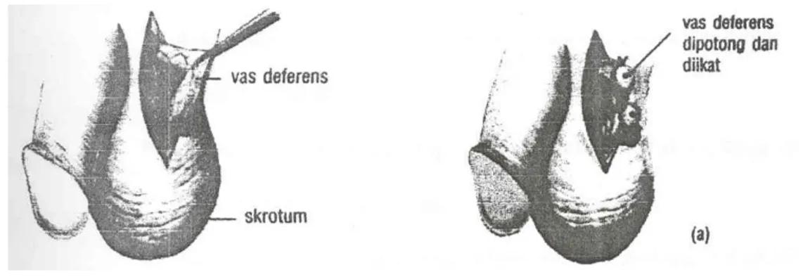 Gambar 2. Alat kontrasepsi pria (tubektomi = pemotongan saluran tuba fallopii)  b.  Kontrasepsi bersifat tidak permanen 