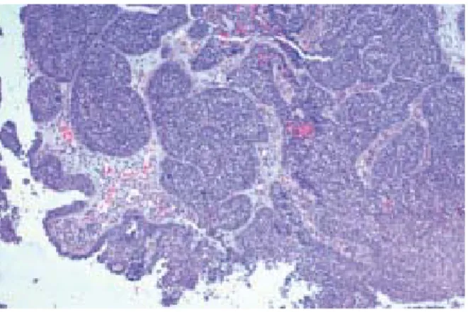 Gambar 2.2. Karsinoma sel skuamosa, non-keratinizing. Pulau-pulau sel-sel tumor 