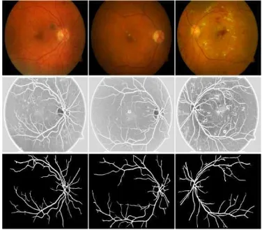 Figure 6. Blood vessel segmentation for DiaretDB: row 1: Original images; row 2: Wavelet based enhanced images; row 3: segmentred blood vessels 