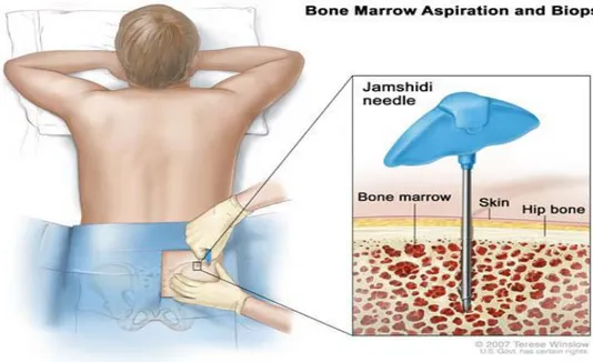 Gambar 2.4. Aspirasi Sumsum Tulang (National Cancer Institute, 2014). 