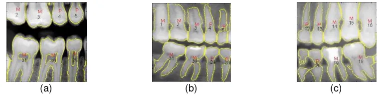 Figure 8. Results of teeth separation applied to three binary images as in Figure 7(a-c);  Top row: maxilla regions