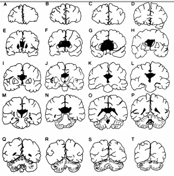 Gambar 4: Head CT Scan Territori Anterior Cerebral Artery coronal section 