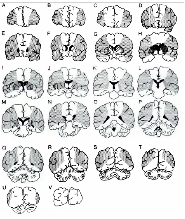 Gambar 8: Head CT Scan territori Middle Cerebral Artery coronal section 
