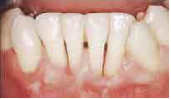 Gambar 1. Splint kawat. Kawat besi lunak (diameter 0.04 mm) dililitkan mengelilingi permukaan fasial dan oral gigi yang akan di-splinting, kemudian ligatur dikencangkan dengan memuntir ujung kawat