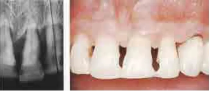 Gambar 4. Splint resin komposit dengan preparasi gigi. Wanita berusia 38 tahun ini tidak ingin mengubah keinginannya bahwa gigi anterior maksila yang terlibat dan hampir tidak dapat diharapkan tersebut harus dipertahankan