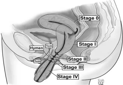 Gambar 2.9Stadium prolaps uterus(Chen, 2007; Schorge dkk., 2012) 