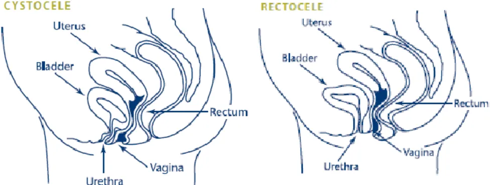 Gambar 2.2 Tipe prolaps organ panggul sistokel dan rektokel (Woman’s Health 