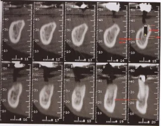 Gambar 14.  Oblique image dari mandibular Dentascan. Image ini dapat digunakan    untuk menentukan panjang implan optimal dan inklinasi relatif gigi di maksila