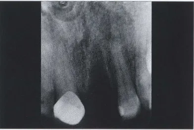 Gambar 25.  Permukaan oklusal maksila setelah pemeriksaan pertama. Gambar memperlihatkan lesi yang muncul saat inflamasi periodontal