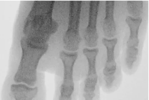 Gambar 7. Citra radiograf kaki volunteer yang dicrop dan di besarkan.