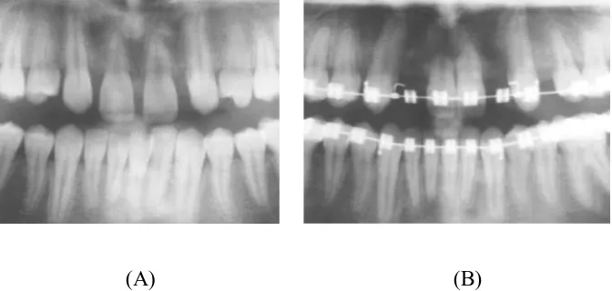 Gambar 11: Resorpsi akar pada gigi insisivus sentralis selama pemakaian alat ortodonti.24 