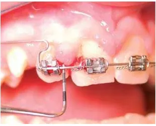 Gambar 12: Pembengkakan gingiva pada pasien ortodonti24 