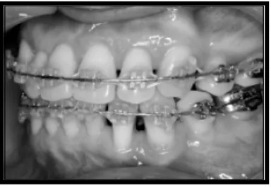 Gambar 14: Ulserasi pada bibir dan Hiperplasia mukosa akibat band orto.1,24 