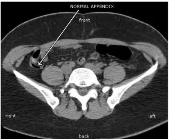 Gambar 2.2. Appendix (Usus Buntu) Normal  source : www.radiopaedia.org 