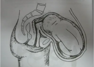 Gambar 3.1 Abdomen Pendulum dengan Kehamilan. 