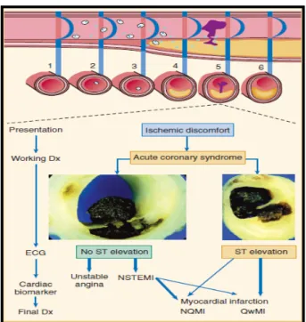 Gambar 3. Patofisiologi terjadinya sindroma    koroner akut (Hamm dkk,2004) 