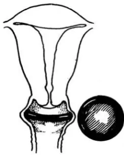 Gambar 2. Cervical Cap 