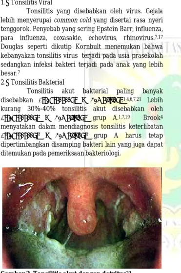 Gambar 2. Tonsilitis akut dengan detritus 22 