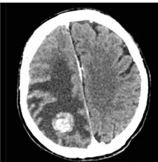 Gambar 4.5. CT Scan Tumor Otak (sumber: Tagle dkk, 2002)