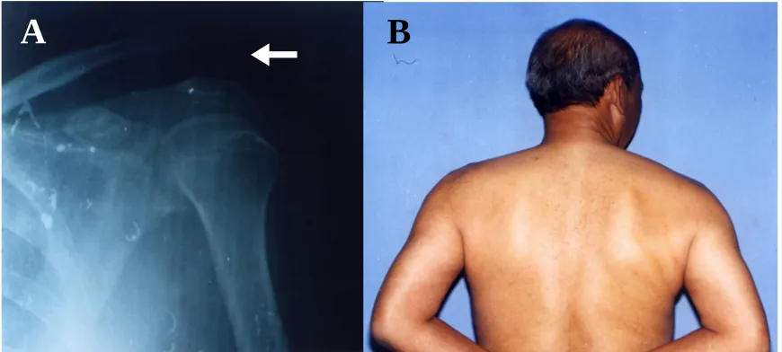 Figure 1 A, Case 1. Anteroposterior roentgenogram of left clavicle at initial examination after neglected Type III