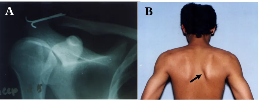 Figure  2  A,  Case  2.  Anteroposterior  roentgenogram  of  right  shoulder  after  operation  of  Type  IIIacromioclavicular joint dislocation