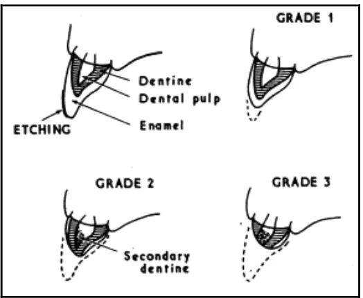 Gambar 7. Gambar derajat erosi gigi: Gambar etching (Et) pada permukaan labial gigi Insisivus sentralis kanan rahang atas35 