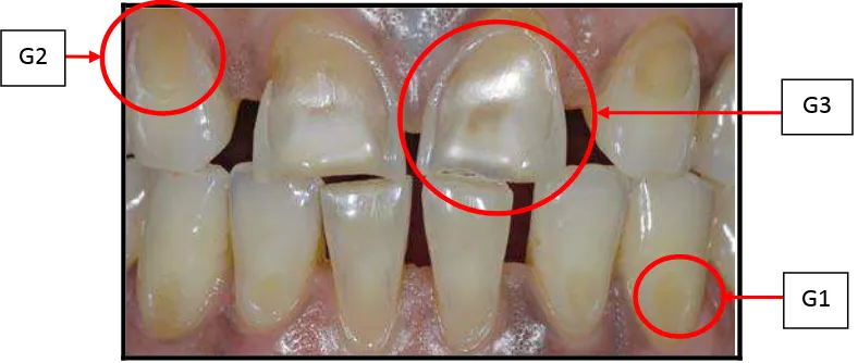 Gambar 8. Gambar derajat erosi gigi: Derajat 1 (G1) erosi gigi pada gigi Kaninus kiri rahang bawah