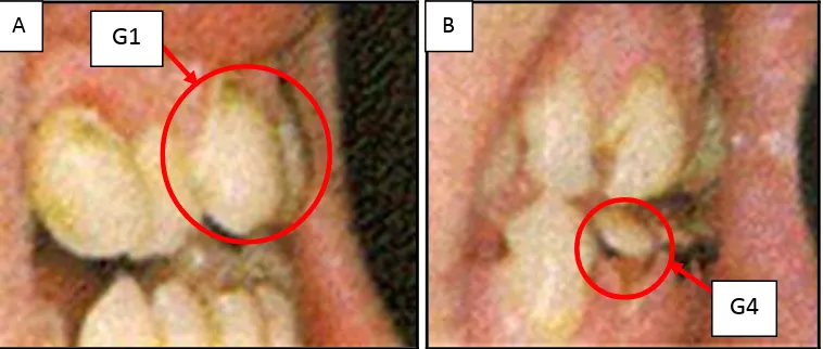 Gambar 10. Gambar lateral derajat erosi gigi: Derajat 1 (G1) erosi gigi pada gigi Insisivus pertama kanan atas (gambar A) dan derajat 2 (G2) erosi gigi pada gigi Insisivus pertama kanan bawah (gambar B)34 