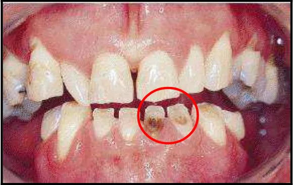 Gambar 11. Gambaran atrisi pada bagian labial gigi Insisivus kiri rahang bawah37 