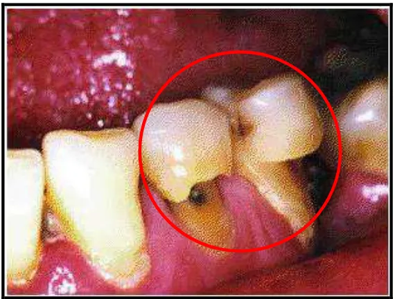 Gambar 12. Gambaran abrasi pada bagian labial gigi  Kaninus dan Premolar rahang bawah40 