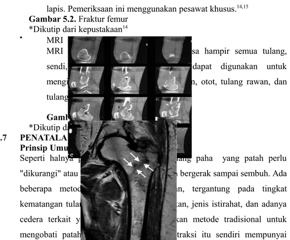Gambar 5.1. Fraktur batang femur *Dikutip dari kepustakaan  12 Contoh foto pemeriksaan radiologis  :