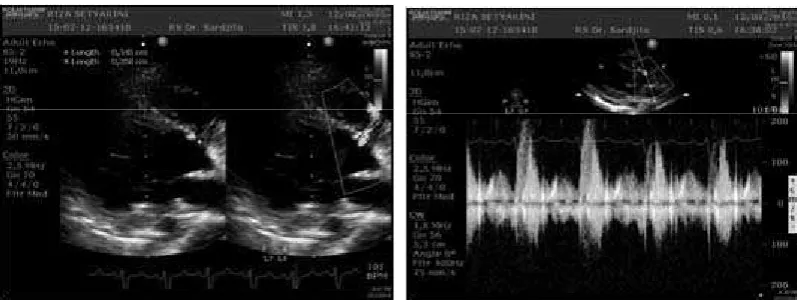 Figure 3. Echocardiogram in post-operation showed residual VSD 3 mm, L to R shunt