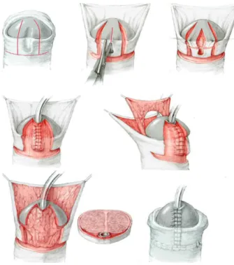 Gambar 2.5. Snodgrass procedure or Tubularized Incised plate  Urethroplasty for distal hypospadias repair (Dikutip dari Hadidi, 2004)