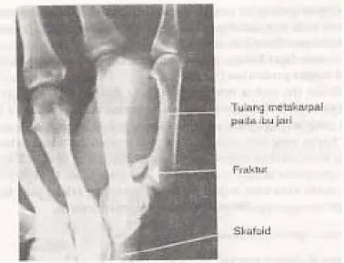 Gambar 7. Foto Rontgen menunjukkan fraktur metakarpal pertama (fraktur Bennet)  Cedera pada jari-jari sangat jarang terjadi, dan cedera pada ibu jari sering  terjadi pada petinju, yaitu fraktura metacarpal I (fraktur Bennet), dan dislokasi pada  ibu jari d