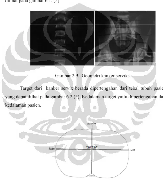 Gambar 2.9.  Geometri kanker serviks. 