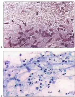 Gambar 2.5. Limfadenitis granulomatosa (tuberkulosis) (A) Kelompokan seperti  granuloma dari histiosit histiosit epiteloid pada latar belakang dari nekrosis  kaseosa granular (MGG); (B) Material granular dari nekrosis kaseosa dengan inti 
