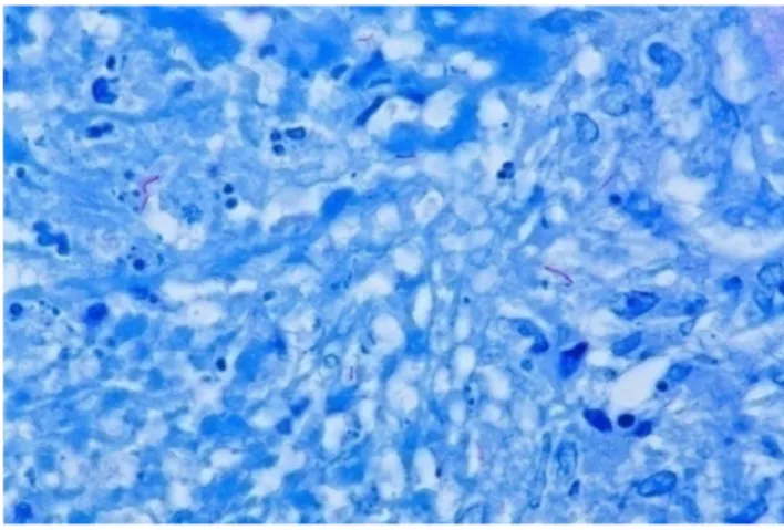 Gambar 2.1. Mycobacterium tuberculosis, dengan pewarnaan Ziehl-Neelsen  pembesaran 1000x  21