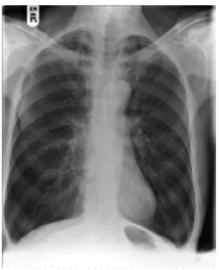Gambar 3.  Gambaran radiologi penderita PPOK.